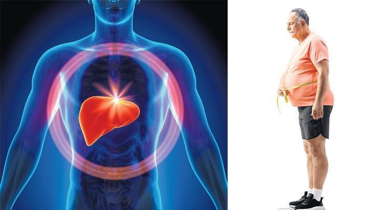 Modern Çağın Görünmez İstilası: Karaciğer Yağlanması Pandemisi ve MASLD Devrimi - Sessizce Kararan Organlar